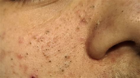 blackheads on you tube